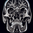 МРТ скронево-нижньощелепного суглоба